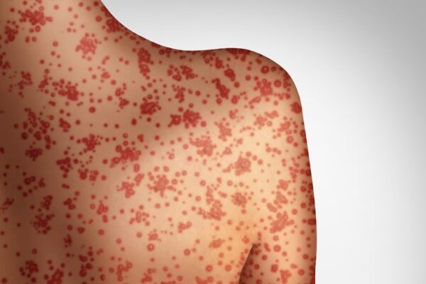 traveler-infected-with-confirmed-case-of-measles-at-seattle-international-airport-as-cases-in-us-increase